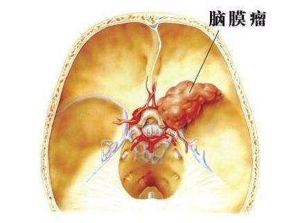 解析脑膜瘤症状从隐秘威胁到警示信号