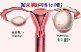 全方位解析，卵巢囊肿的自然疗法与现代医学对策