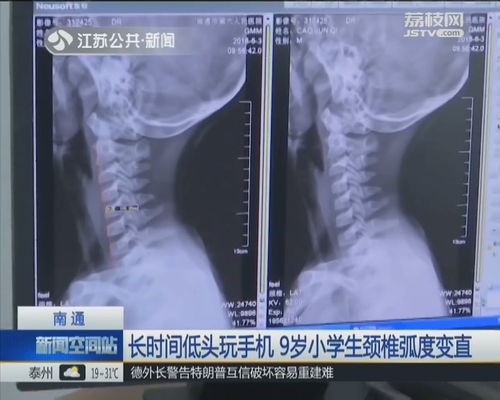 颈部淋巴癌早期识别与养生保健，理性面对，科学防治