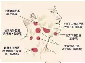 颈部淋巴结核，识别、护理与健康全面指南