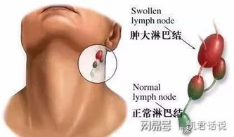 颈部淋巴结核，识别、护理与健康全面指南