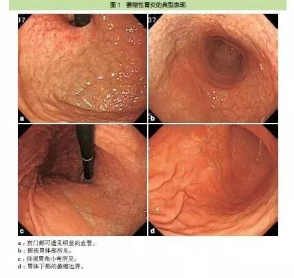 全面解析，萎缩性胃炎的病症与高效治疗指南