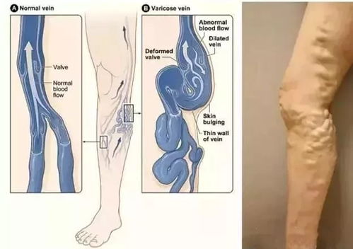 全方位揭秘，远离静脉曲张的养生秘籍——全方位预防策略