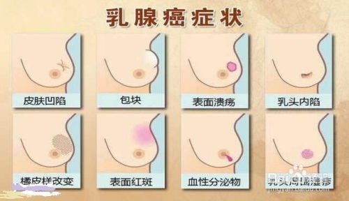 全面解析，乳腺癌的早期症状与养生保健之道