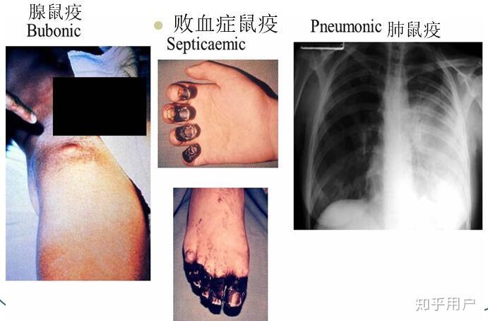 鼠疫的主要症状