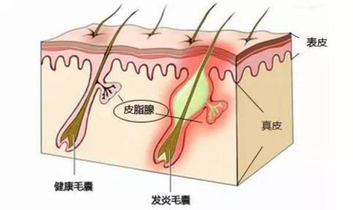 全面揭秘上海痤疮治疗攻略，专业医院与养生理念并重