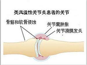 全面解析，关节炎的养生之道与高效治疗方法