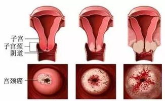 全面揭秘，宫颈糜烂的早期警示信号，健康养生必看指南