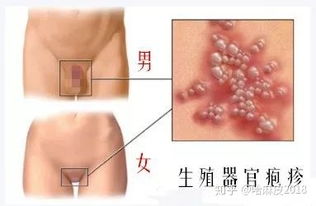 男性霉菌性阴炎全面解析与健康养生指南