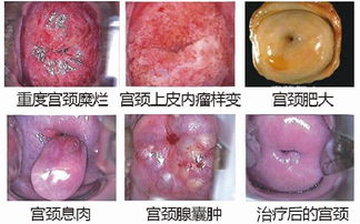 专业解析宫颈糜烂症状与防治全指南——图解清晰识别与健康守护