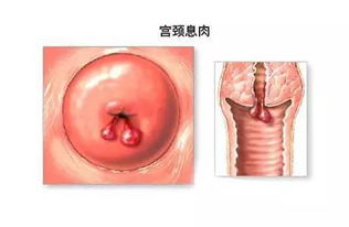 专业解析宫颈糜烂症状与防治全指南——图解清晰识别与健康守护