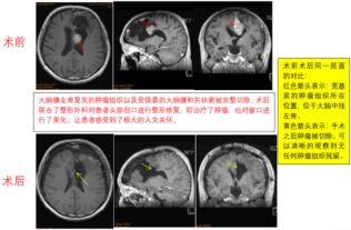 康复之路，脑瘤手术后的生存期与生活质量探讨