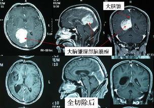 康复之路，脑瘤手术后的生存期与生活质量探讨