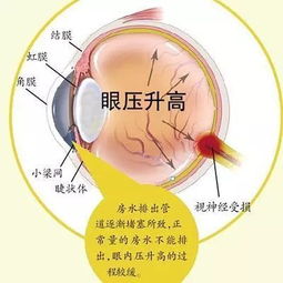 认识眼压高，症状、原因与对策，守护您的视界健康