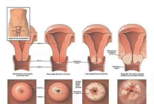 揭秘宫颈癌的早期信号，那些你可能忽视的警示信号