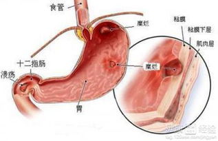 胃出血，严重性与应对策略全解析