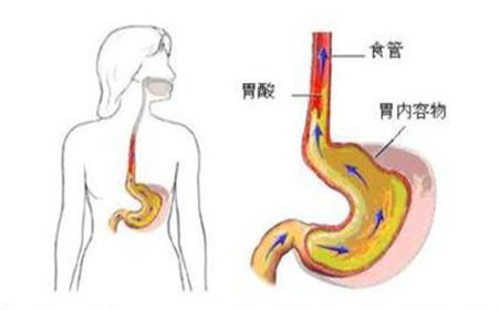 掌握这些信号，深度解析反流性食管炎的警示与对策