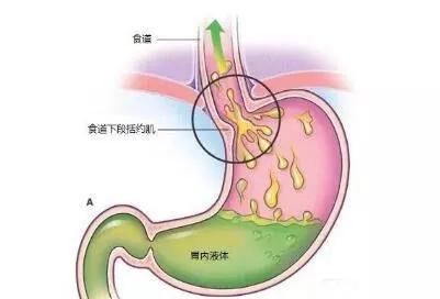 掌握这些信号，深度解析反流性食管炎的警示与对策