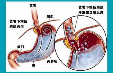 掌握这些信号，深度解析反流性食管炎的警示与对策