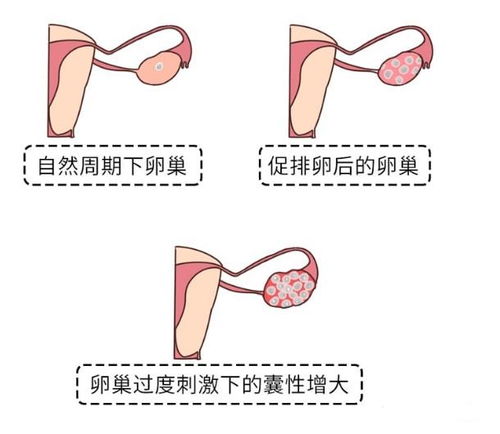 揭秘卵巢小秘密，那些你可能忽视的不适信号