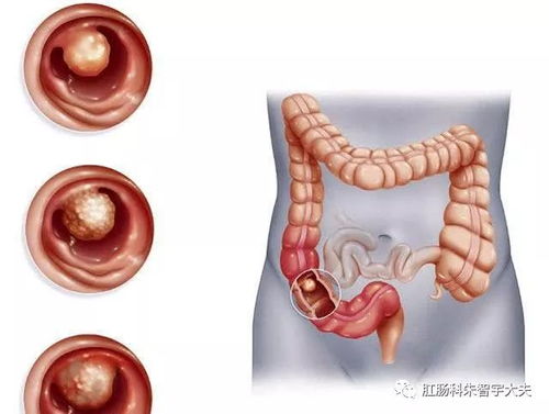 早期肠癌的警示信号，辨别大便图片，守护肠道健康