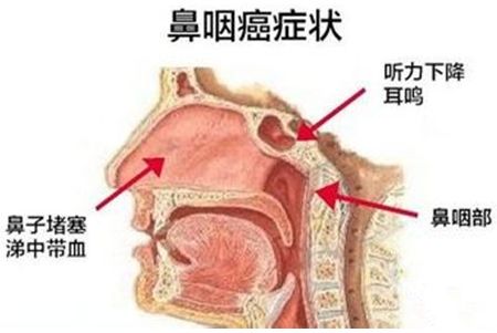 揭示鼻咽癌晚期信号，警惕这些不为人知的症状