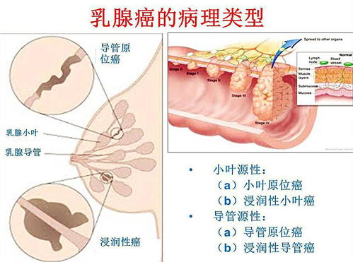 36岁女子胸部疙瘩的警报，乳腺癌的早期识别与预防