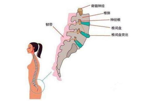 全面解析，腰肌劳损的十大症状与养生对策