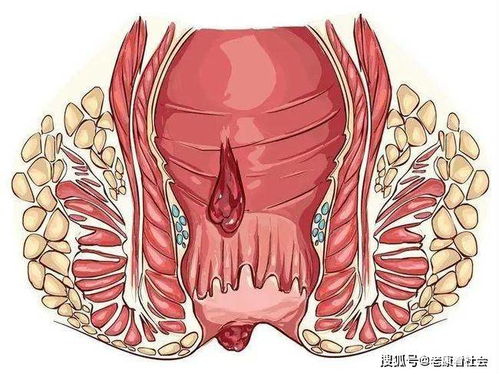 战胜痔疮，全面了解和有效治疗策略