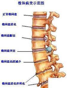 全面解析，骨质增生的防治之道——从生活到科学，全方位养生指南