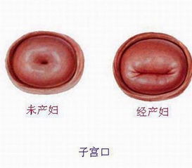 了解宫颈糜烂，症状、原因与对策全解析