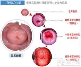 了解宫颈糜烂，症状、原因与对策全解析