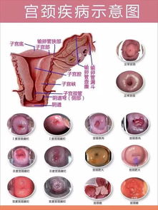 全面解析，女性囊肿，病因、危害与健康养护全攻略