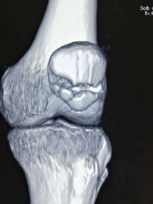 康复之路，理解和应对髌骨粉碎性骨折的全面指南