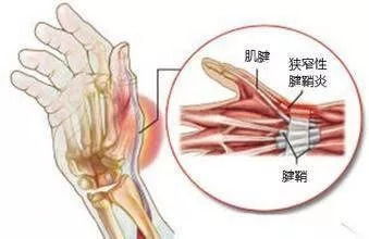 揭秘腱鞘炎，症状、原因与防治全攻略