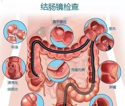 探秘肠道的秘密武器，6个信号，别错过肠镜检查！