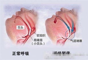 揭秘多囊卵巢综合症，症状、原因与健康养生之道