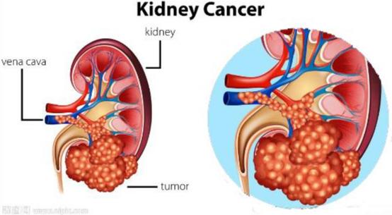 肾癌，复发风险与五年生存率的全面解析