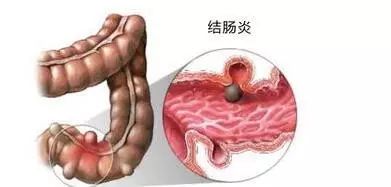 早期察觉，直肠癌的五大微妙信号——你的健康守护神