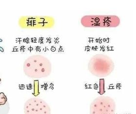 揭秘人工荨麻疹，症状、原因与日常护理全指南