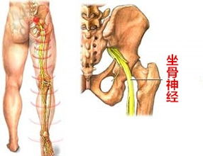 坐骨神经痛，识别、应对与康复全攻略