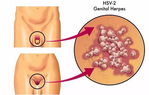 全方位解析，科学应对生殖器疱疹，养生达人的健康指南