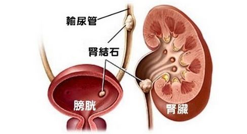 探秘水袋肾的秘密，肾积水那些你可能忽视的信号