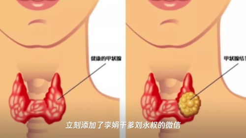 健康守护甲状腺肿大的隐形隐形朋友，科学对策与日常生活指南